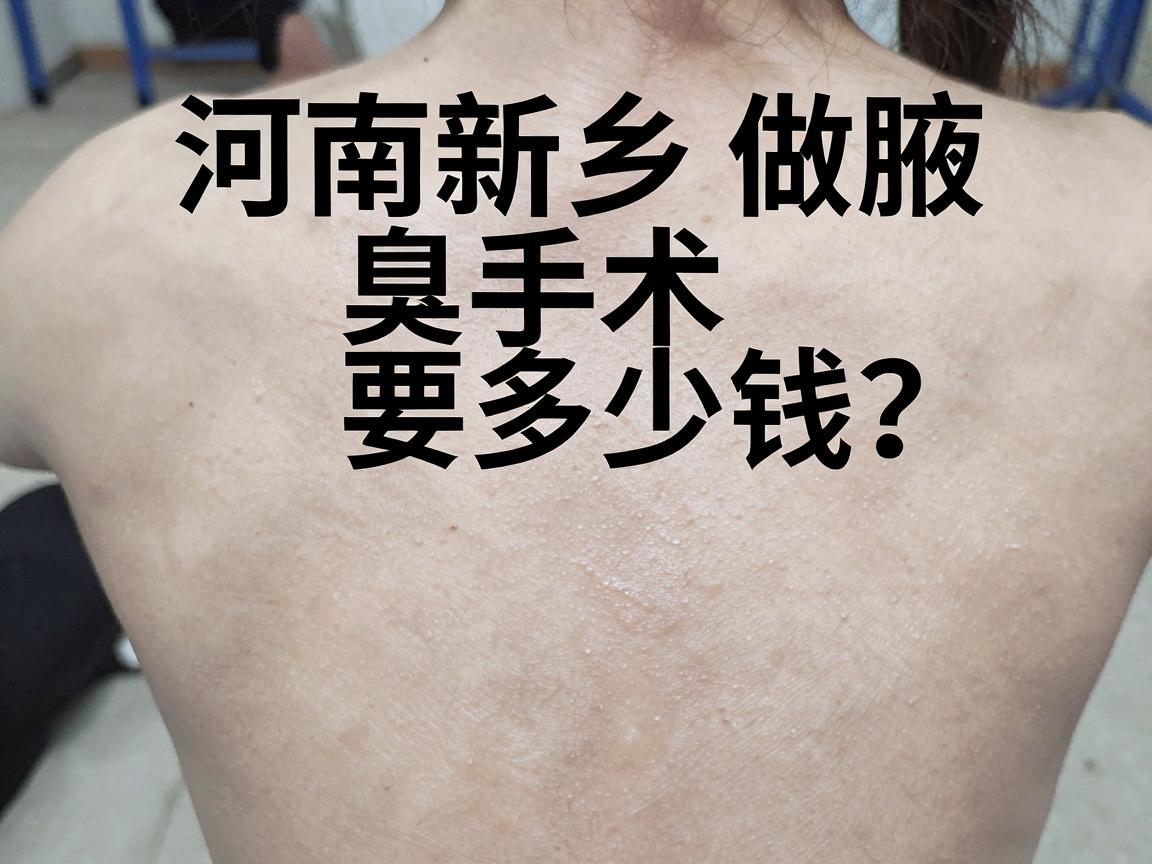 河南新乡做腋臭手术要多少钱？一文讲清新乡腋臭手术价格与真实费用构成