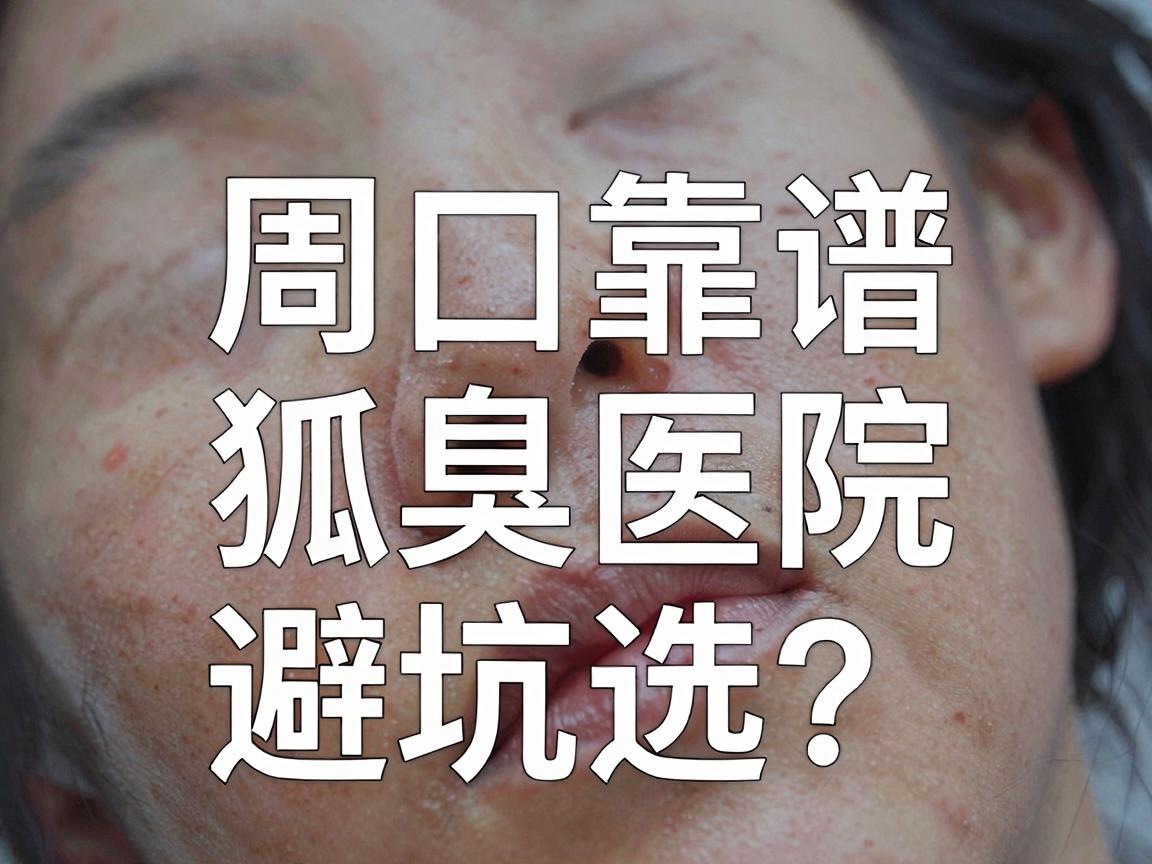 周口狐臭手术怎么选？周口靠谱狐臭医院避坑指南